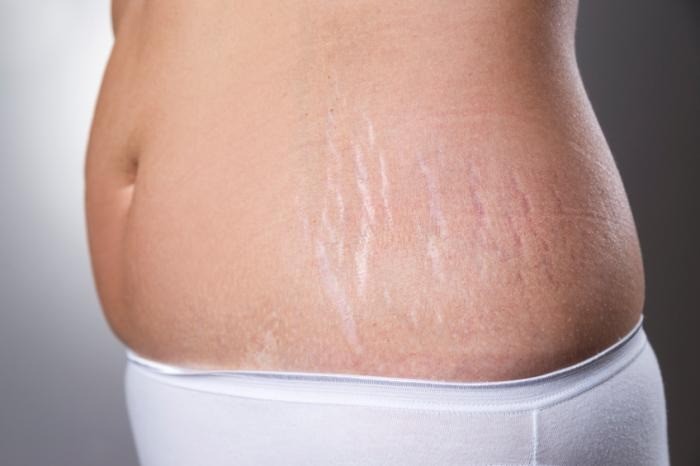 Stretch Mark Treatment